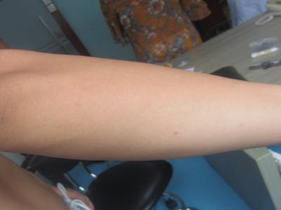 我得了点滴性牛皮癣怎么办