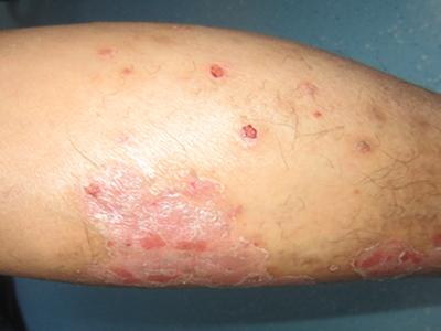 患上牛皮癣有哪些危害