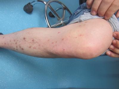 得了牛皮癣好治疗吗