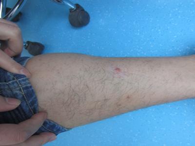 牛皮癣的症状是什么