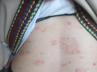 怎么确诊是不是牛皮癣