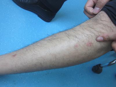 面部红掉皮,是不是牛皮癣