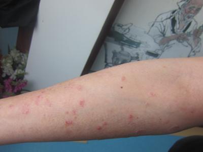 我有牛皮癣快崩溃了求助