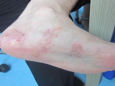 牛皮癣困扰多年,希望能缓解根治