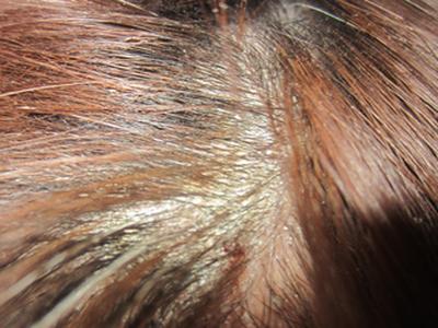 治疗牛皮癣有什么好的办法