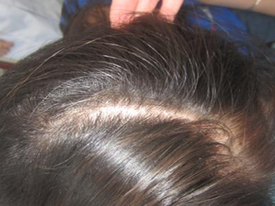 血热型牛皮癣口服什么药物较好