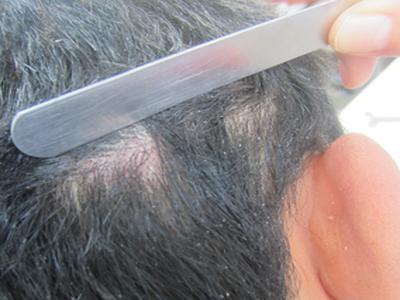 牛皮癣加重如何治疗