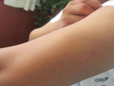 有牛皮癣十几年了如何治疗