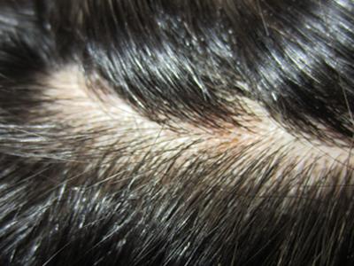 寻常型牛皮癣吃什么中药