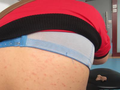 牛皮癣病情有好转的表现是什么