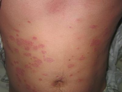 得了牛皮癣需要做哪些检查