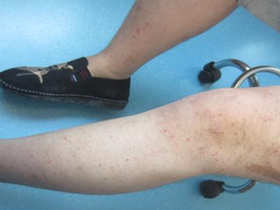 如何避免牛皮癣的反复