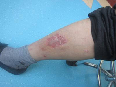 牛皮癣的治疗常识有哪些