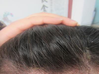 牛皮癣的出现有何危害