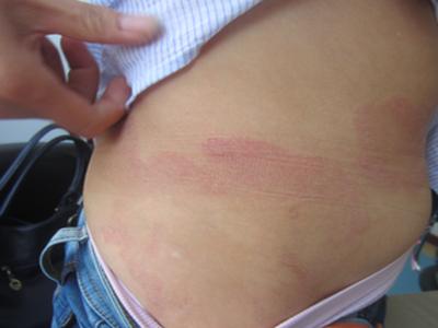 怎么判断患处的皮损就是牛皮癣呢