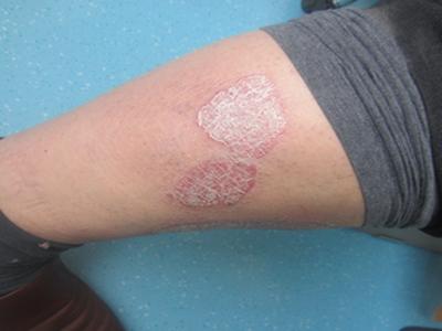 预防牛皮癣要怎么做