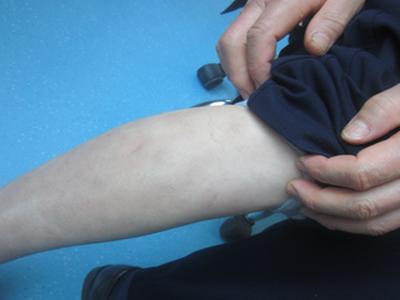 牛皮癣出现复发需怎样进行预防呢