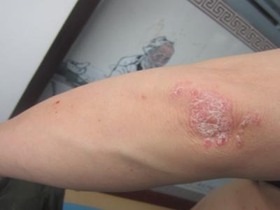 得了牛皮癣怎么用药