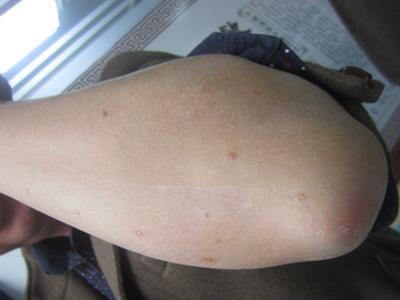 牛皮癣还您健康后如何有效的避免反复