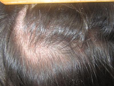 在治疗牛皮癣的时候应该要做好哪些防护事宜呢