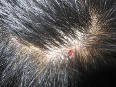 牛皮癣的初期症状