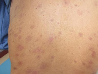 在河南怎样选择治疗银屑病的医院