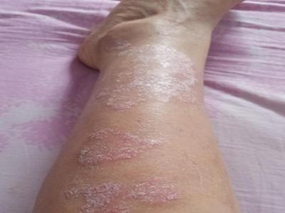 郑州哪家中医院治牛皮癣比较好呢