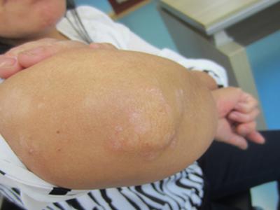 梁头灰加醋可以治牛皮癣吗