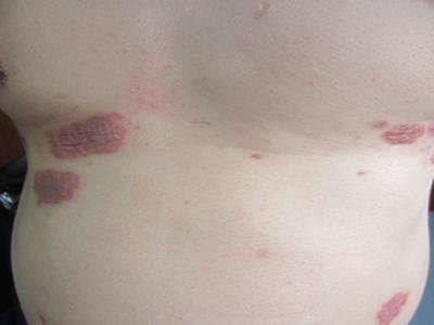 郑州牛皮癣皮肤病专科医院