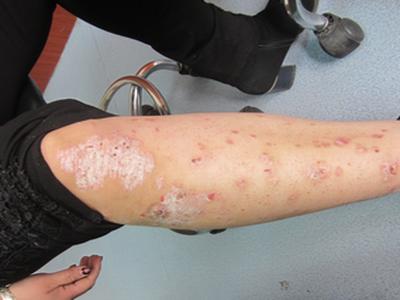 郑州治疗牛皮癣较好的医院是哪家