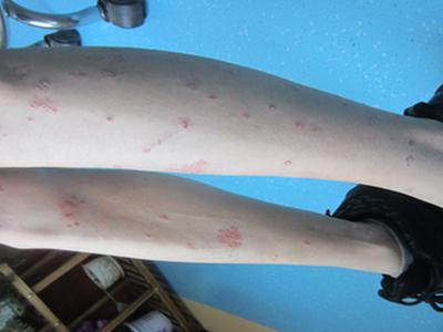 患有牛皮癣能治好吗