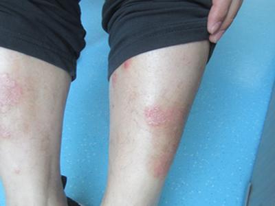 治疗牛皮癣的费用要多少