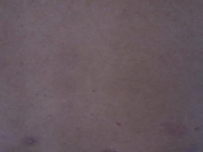 治疗牛皮癣的偏方是什么