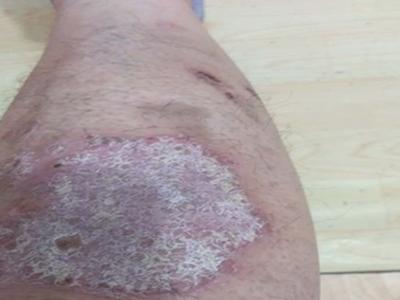 我的免疫力低下引起的牛皮癣该怎么治