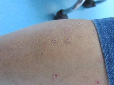 牛皮廨治疗需要多久才能好