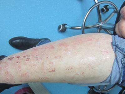 得了牛皮癣怎么进行心理治疗