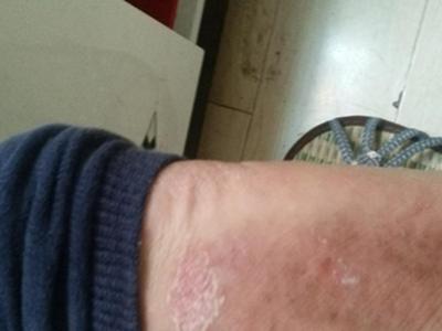 孩子身上有牛皮癣是什么引起的