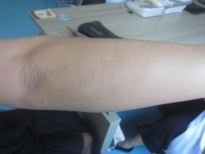 银屑病用什么药效果好