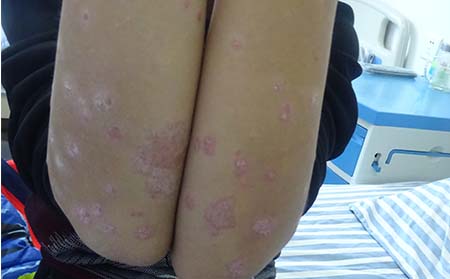 牛皮癣怎么控制发展