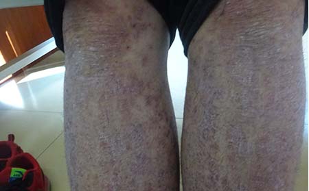 卡泊三醇搽剂治疗牛皮癣的效果怎样