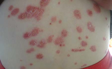 什么偏方能够治愈头部牛皮癣