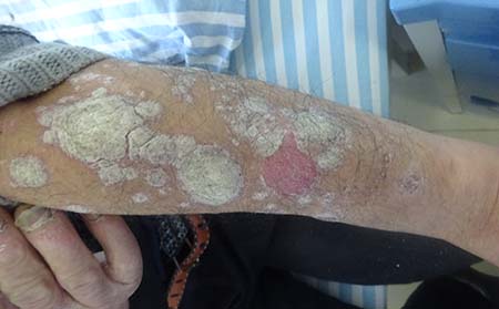 牛皮癣红斑会自己消失吗