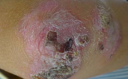 克银胶囊可以根治牛皮癣吗