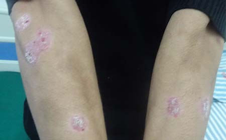 用药物治疗牛皮癣真的能痊愈么