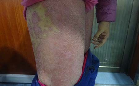 在郑州怎么治疗牛皮癣有好的效果