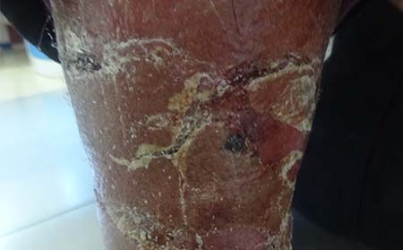 牛皮癣的症状特征都有哪些呢