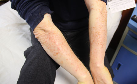 牛皮癣患者怎么调节心态呢