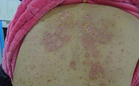 牛皮癣患者的心态调整应该注意哪些问题