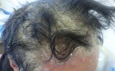 什么情况牛皮癣容易出现扩散