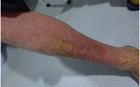 牛皮癣出现反复之后应该怎么办